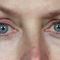 Restylane®