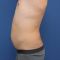 Water-jet liposukce (WAL - body-jet)
