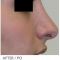 Rhinoplasty (Nose Job)