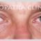 Eyelid surgery (Blepharoplasty)