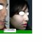 Rhinoplastie