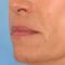 Injections d