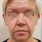 Facelift, SMAS facelifting