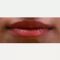 Lip augmentation - cheiloplasty
