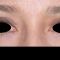 Cirugía de párpados (Blefaroplastia)