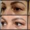 Operácia očných viečok (Blepharoplastika)