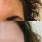 Procedure laser in dermatologia estetica