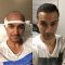 Haartransplantation