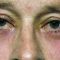 Eyelid surgery (Blepharoplasty)