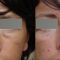Injections de comblement
