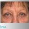 Facelift, SMAS facelifting