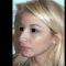 Rhinoplastie