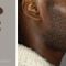 Chirurgie du double-menton