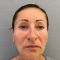 Nichtchirurgische Faltenbehandlung - BOTOX® / DYSPORT®