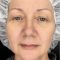 Fotorejuvenation