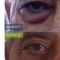 Blépharoplastie inférieure