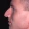 Rhinoplasty (Nose Job)