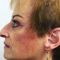 Facelift
