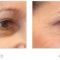 Hyaluronic acid-based wrinkle fillers