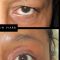 Blépharoplastie