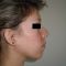 Génioplastie - Chirurgie esthétique du menton
