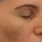 Operácia nosa (Rhinoplastika)