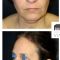 Mini lifting (lifting cervico-facial)
