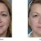 PRP – Plazma terapie (Platelet Rich Plasma)
