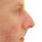 Operácia nosa (Rhinoplastika)