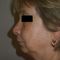 Lifting du visage