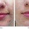 Laser acne treatment