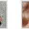 Rhinoplasty (Nose Job)