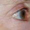 Fotorejuvenace / Resurfacing