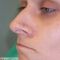 Laser Scar Treatment