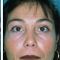 Chemisches Peeling