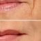 Filler