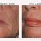 Sculptra