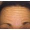 Botulinum toxin - Wrinkle Removal