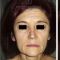 Facelift