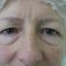 Operácia očných viečok (Blepharoplastika)