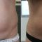 Liposukcja laserowa
