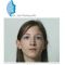Otoplastie (Chirurgie esthétique des oreilles)
