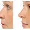 Restylane®