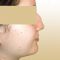 Rhinoplasty (Nose Job)