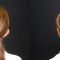 Ear surgery (Otoplasty)