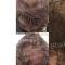 Trapianto capelli