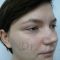 Septoplasty