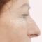Operácia nosa (Rhinoplastika)