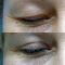 Eyelid surgery (Blepharoplasty)