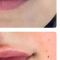 Kwas hialuronowy: Saypha, Restylane, Juvederm, Stylage